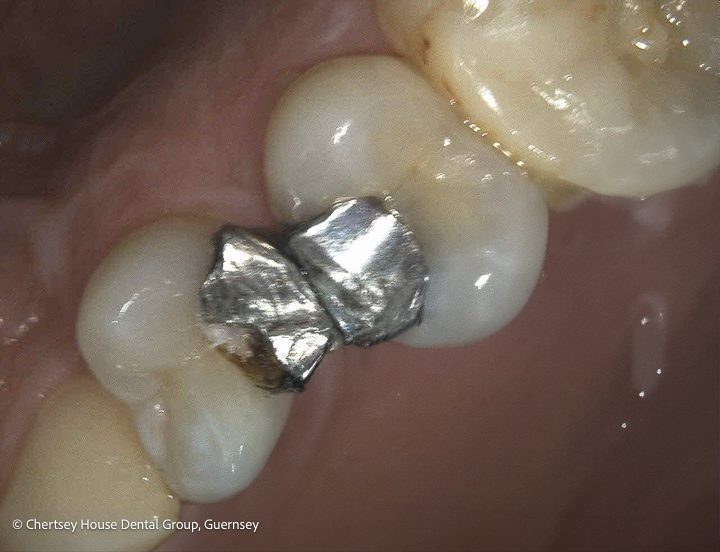 Chertsey House Implants