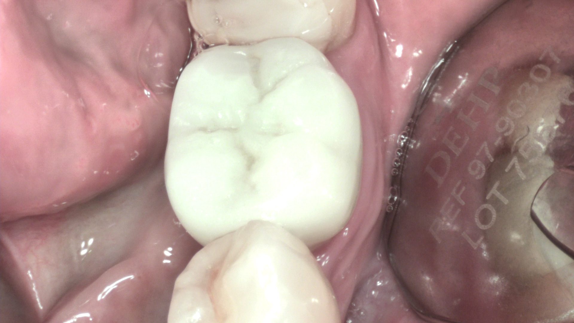 Chertsey House Implants