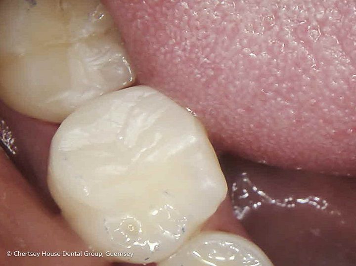 Chertsey House Implants
