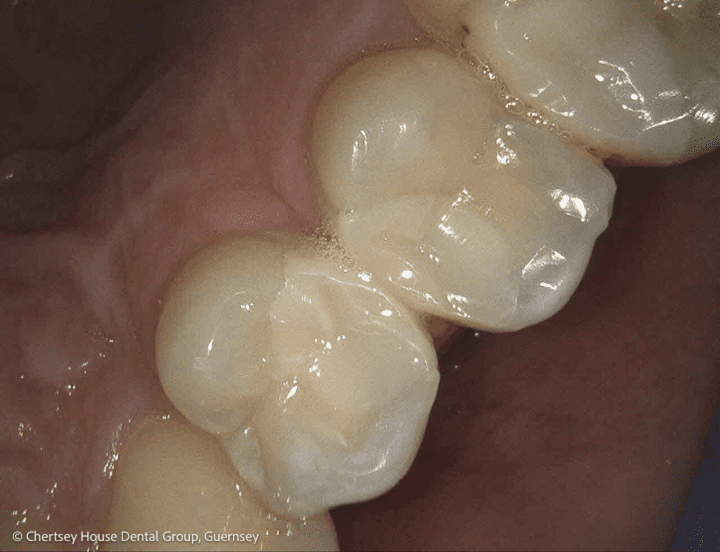 Chertsey House Implants